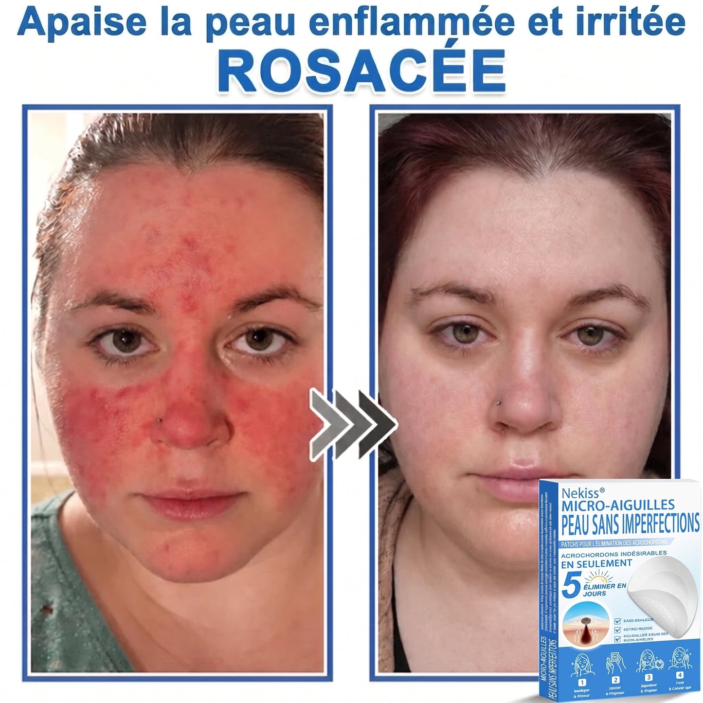 💧💧 𝑩𝒐𝒖𝒕𝒊𝒒𝒖𝒆 𝑶𝒇𝒇𝒊𝒄𝒊𝒆𝒍𝒍𝒆|𝐍𝐞𝐊𝐢𝐬𝐬® 🌿𝐏𝐚𝐭𝐜𝐡 𝐇𝐲𝐝𝐫𝐨𝐜𝐨𝐥𝐥𝐨ï𝐝𝐞 𝐁𝐨𝐭𝐚𝐧𝐢𝐪𝐮𝐞 à 𝐌𝐢𝐜𝐫𝐨-𝐀𝐢𝐠𝐮𝐢𝐥𝐥𝐞𝐬( 𝐂𝐢𝐛𝐥𝐞 𝐥𝐞𝐬 𝐚𝐜𝐫𝐨𝐜𝐡𝐨𝐫𝐝𝐨𝐧𝐬, 𝐩𝐞𝐭𝐢𝐭𝐞𝐬 𝐞𝐱𝐜𝐫𝐨𝐢𝐬𝐬𝐚𝐧𝐜𝐞𝐬, 𝐯𝐞𝐫𝐫𝐮𝐞𝐬, 𝐠𝐫𝐚𝐢𝐧𝐬 𝐝𝐞 𝐛𝐞𝐚𝐮𝐭é, 𝐭𝐚𝐜𝐡𝐞𝐬 𝐝𝐞 𝐯𝐢𝐞𝐢𝐥𝐥𝐞𝐬𝐬𝐞 𝐞𝐭 𝐚𝐮𝐭𝐫𝐞𝐬 𝐢𝐦𝐩𝐞𝐫𝐟𝐞𝐜𝐭𝐢𝐨𝐧𝐬 𝐜𝐮𝐭𝐚𝐧é𝐞𝐬 𝐨𝐮 𝐩𝐢𝐠𝐦𝐞𝐧𝐭𝐚𝐢𝐫𝐞𝐬 )