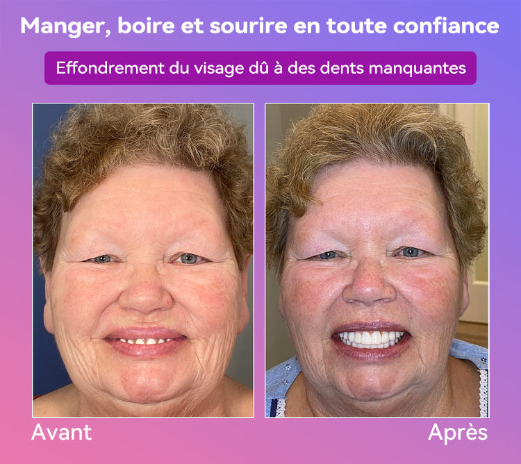 𝐉𝐚𝐬𝐬𝐞𝐞𝐦® Dernières Prothèses Dentaires Premium Confort🏆 (Prothèses haut de gamme, Confortables à Porter - Remise de 70% pour une durée limitée)🔥