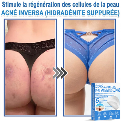 👩‍⚕️🎁 𝑩𝒐𝒖𝒕𝒊𝒒𝒖𝒆 𝑶𝒇𝒇𝒊𝒄𝒊𝒆𝒍𝒍𝒆|🌿Pansements hydrocolloïdes à micro-aiguilles 𝑵𝐞𝑲𝐢𝐬𝐬® 2-en-1
