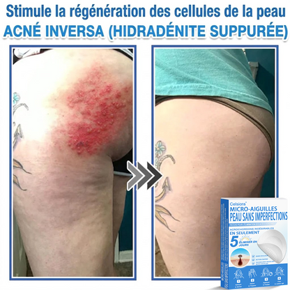 👩‍⚕️🎁 𝑩𝒐𝒖𝒕𝒊𝒒𝒖𝒆 𝑶𝒇𝒇𝒊𝒄𝒊𝒆𝒍𝒍𝒆|🌿Pansements hydrocolloïdes à micro-aiguilles 𝑵𝐞𝑲𝐢𝐬𝐬® 2-en-1