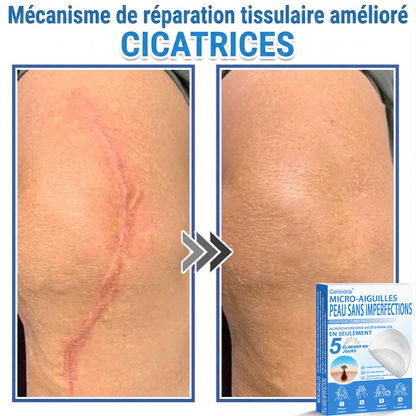 👩‍⚕️🎁 𝑩𝒐𝒖𝒕𝒊𝒒𝒖𝒆 𝑶𝒇𝒇𝒊𝒄𝒊𝒆𝒍𝒍𝒆|🌿Pansements hydrocolloïdes à micro-aiguilles 𝑵𝐞𝑲𝐢𝐬𝐬® 2-en-1
