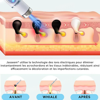 𝐉𝐚𝐬𝐬𝐞𝐞𝐦® Stylo Laser de Qualité Médicale 🏆 (utilise la technologie laser au CO₂ – efficace pour éliminer les grains de beauté, les verrues, les acrochordons, les taches pigmentaires et autres imperfections)🔥