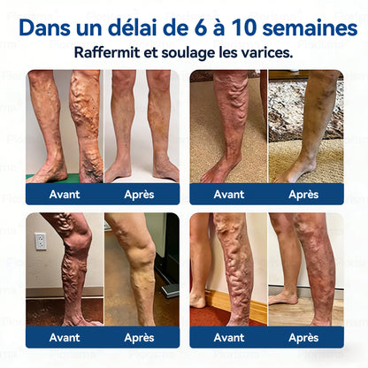🛡️ 𝑭𝑳𝑶𝑹𝑰𝑺𝑴𝑨® 🎉 Patch à Micro‑aiguilles de Grade Clinique au Diosmine & Hespéridine — Un mélange avancé d’extraits végétaux conçu pour cibler les varicosités et les varices tout en aidant à soulager les jambes lourdes et fatiguées. 👩‍⚕️