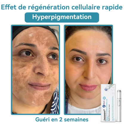 𝐉𝐚𝐬𝐬𝐞𝐞𝐦® Stylo Laser de Qualité Médicale 🏆 (utilise la technologie laser au CO₂ – efficace pour éliminer les grains de beauté, les verrues, les acrochordons, les taches pigmentaires et autres imperfections)🔥