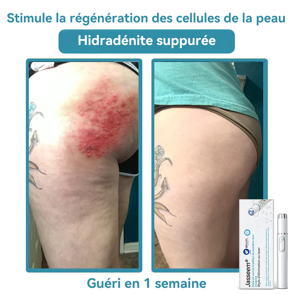 1 pièce – (Élimination professionnelle non invasive des grains de beauté et des verrues)