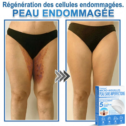 👩‍⚕️🎁 𝑩𝒐𝒖𝒕𝒊𝒒𝒖𝒆 𝑶𝒇𝒇𝒊𝒄𝒊𝒆𝒍𝒍𝒆|🌿Pansements hydrocolloïdes à micro-aiguilles 𝑵𝐞𝑲𝐢𝐬𝐬® 2-en-1