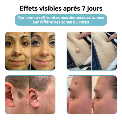 𝐉𝐚𝐬𝐬𝐞𝐞𝐦® Stylo Laser de Qualité Médicale 🏆 (utilise la technologie laser au CO₂ – efficace pour éliminer les grains de beauté, les verrues, les acrochordons, les taches pigmentaires et autres imperfections)🔥