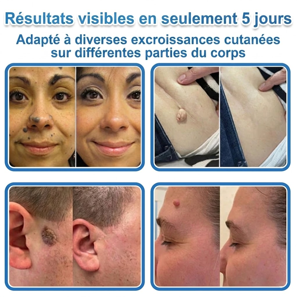 💧💧 𝑩𝒐𝒖𝒕𝒊𝒒𝒖𝒆 𝑶𝒇𝒇𝒊𝒄𝒊𝒆𝒍𝒍𝒆|𝐍𝐞𝐊𝐢𝐬𝐬® 🌿𝐏𝐚𝐭𝐜𝐡 𝐇𝐲𝐝𝐫𝐨𝐜𝐨𝐥𝐥𝐨ï𝐝𝐞 𝐁𝐨𝐭𝐚𝐧𝐢𝐪𝐮𝐞 à 𝐌𝐢𝐜𝐫𝐨-𝐀𝐢𝐠𝐮𝐢𝐥𝐥𝐞𝐬( 𝐂𝐢𝐛𝐥𝐞 𝐥𝐞𝐬 𝐚𝐜𝐫𝐨𝐜𝐡𝐨𝐫𝐝𝐨𝐧𝐬, 𝐩𝐞𝐭𝐢𝐭𝐞𝐬 𝐞𝐱𝐜𝐫𝐨𝐢𝐬𝐬𝐚𝐧𝐜𝐞𝐬, 𝐯𝐞𝐫𝐫𝐮𝐞𝐬, 𝐠𝐫𝐚𝐢𝐧𝐬 𝐝𝐞 𝐛𝐞𝐚𝐮𝐭é, 𝐭𝐚𝐜𝐡𝐞𝐬 𝐝𝐞 𝐯𝐢𝐞𝐢𝐥𝐥𝐞𝐬𝐬𝐞 𝐞𝐭 𝐚𝐮𝐭𝐫𝐞𝐬 𝐢𝐦𝐩𝐞𝐫𝐟𝐞𝐜𝐭𝐢𝐨𝐧𝐬 𝐜𝐮𝐭𝐚𝐧é𝐞𝐬 𝐨𝐮 𝐩𝐢𝐠𝐦𝐞𝐧𝐭𝐚𝐢𝐫𝐞𝐬 )