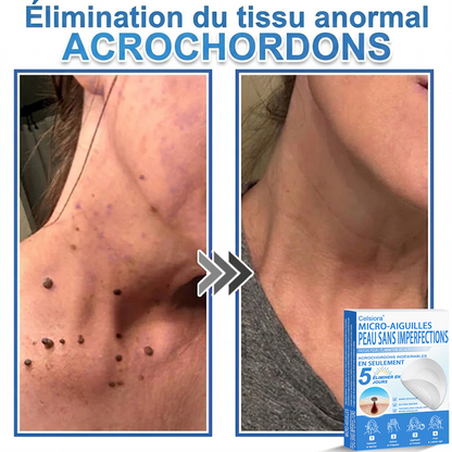 👩‍⚕️🎁 𝑩𝒐𝒖𝒕𝒊𝒒𝒖𝒆 𝑶𝒇𝒇𝒊𝒄𝒊𝒆𝒍𝒍𝒆|🌿Pansements hydrocolloïdes à micro-aiguilles 𝑵𝐞𝑲𝐢𝐬𝐬® 2-en-1
