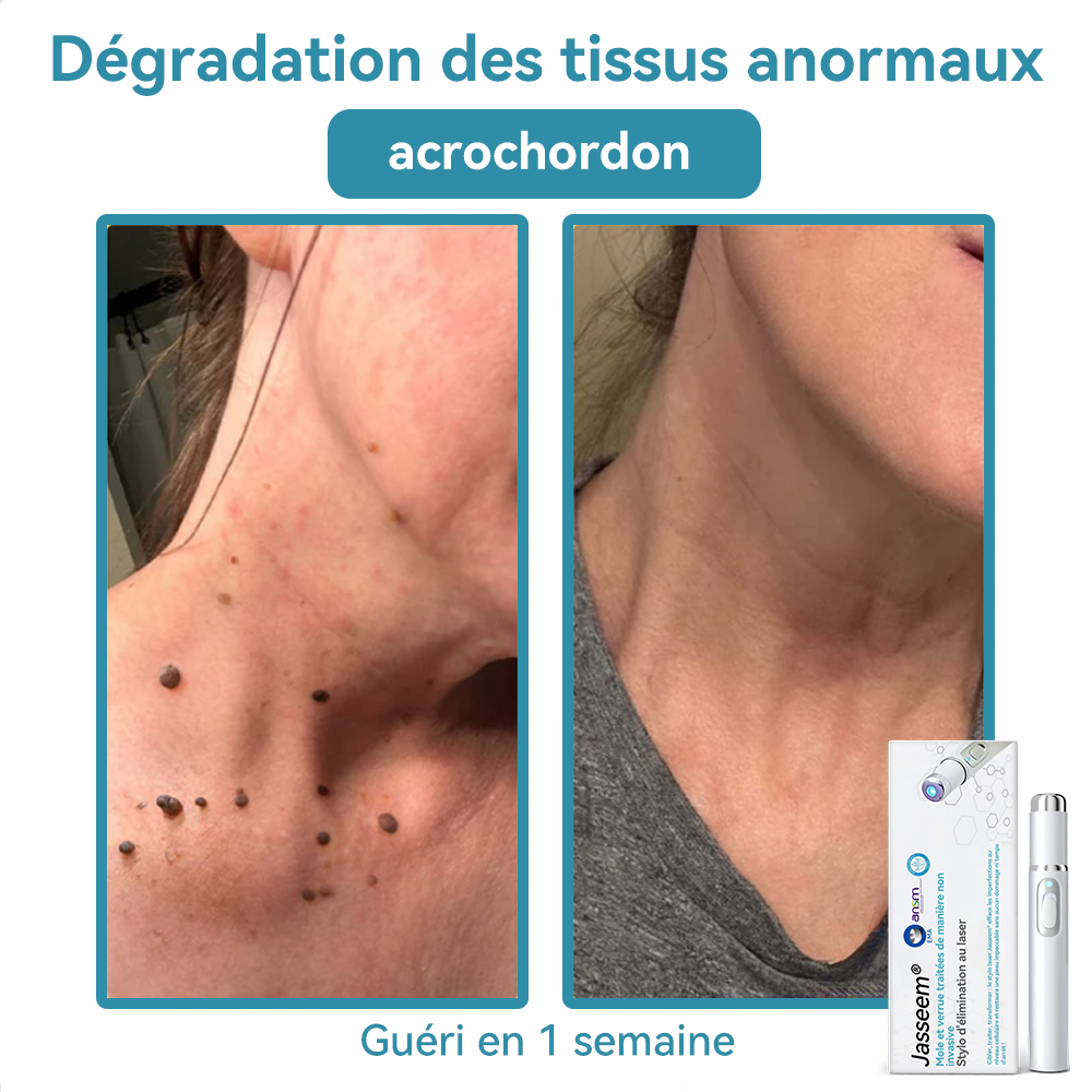 𝐉𝐚𝐬𝐬𝐞𝐞𝐦® Stylo Laser de Qualité Médicale 🚚🎁(utilise la technologie laser au CO₂ – efficace pour éliminer les grains de beauté, les verrues, les acrochordons, les taches pigmentaires et autres imperfections)