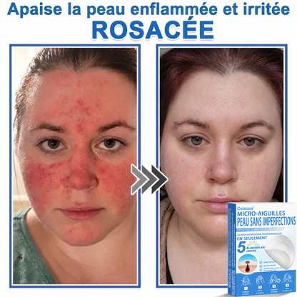 👩‍⚕️🎁 𝑩𝒐𝒖𝒕𝒊𝒒𝒖𝒆 𝑶𝒇𝒇𝒊𝒄𝒊𝒆𝒍𝒍𝒆|🌿Pansements hydrocolloïdes à micro-aiguilles 𝑵𝐞𝑲𝐢𝐬𝐬® 2-en-1