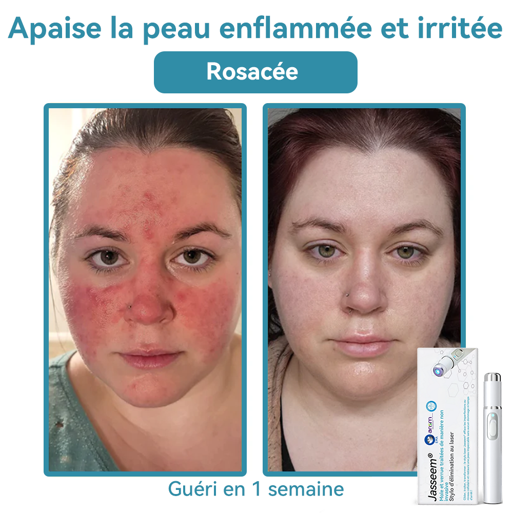 𝐉𝐚𝐬𝐬𝐞𝐞𝐦® Stylo Laser de Qualité Médicale 🚚🎁(utilise la technologie laser au CO₂ – efficace pour éliminer les grains de beauté, les verrues, les acrochordons, les taches pigmentaires et autres imperfections)