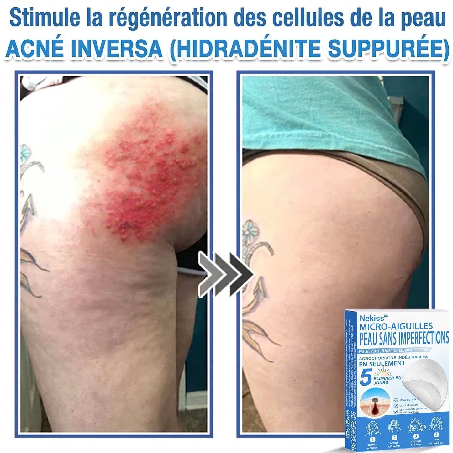 💧💧 𝑩𝒐𝒖𝒕𝒊𝒒𝒖𝒆 𝑶𝒇𝒇𝒊𝒄𝒊𝒆𝒍𝒍𝒆|𝐍𝐞𝐊𝐢𝐬𝐬® 🌿𝐏𝐚𝐭𝐜𝐡 𝐇𝐲𝐝𝐫𝐨𝐜𝐨𝐥𝐥𝐨ï𝐝𝐞 𝐁𝐨𝐭𝐚𝐧𝐢𝐪𝐮𝐞 à 𝐌𝐢𝐜𝐫𝐨-𝐀𝐢𝐠𝐮𝐢𝐥𝐥𝐞𝐬( 𝐂𝐢𝐛𝐥𝐞 𝐥𝐞𝐬 𝐚𝐜𝐫𝐨𝐜𝐡𝐨𝐫𝐝𝐨𝐧𝐬, 𝐩𝐞𝐭𝐢𝐭𝐞𝐬 𝐞𝐱𝐜𝐫𝐨𝐢𝐬𝐬𝐚𝐧𝐜𝐞𝐬, 𝐯𝐞𝐫𝐫𝐮𝐞𝐬, 𝐠𝐫𝐚𝐢𝐧𝐬 𝐝𝐞 𝐛𝐞𝐚𝐮𝐭é, 𝐭𝐚𝐜𝐡𝐞𝐬 𝐝𝐞 𝐯𝐢𝐞𝐢𝐥𝐥𝐞𝐬𝐬𝐞 𝐞𝐭 𝐚𝐮𝐭𝐫𝐞𝐬 𝐢𝐦𝐩𝐞𝐫𝐟𝐞𝐜𝐭𝐢𝐨𝐧𝐬 𝐜𝐮𝐭𝐚𝐧é𝐞𝐬 𝐨𝐮 𝐩𝐢𝐠𝐦𝐞𝐧𝐭𝐚𝐢𝐫𝐞𝐬 )
